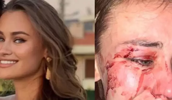 Ünlü top model Daria Kyryliuk dayak yedi, Şeyma Subaşı isyan etti